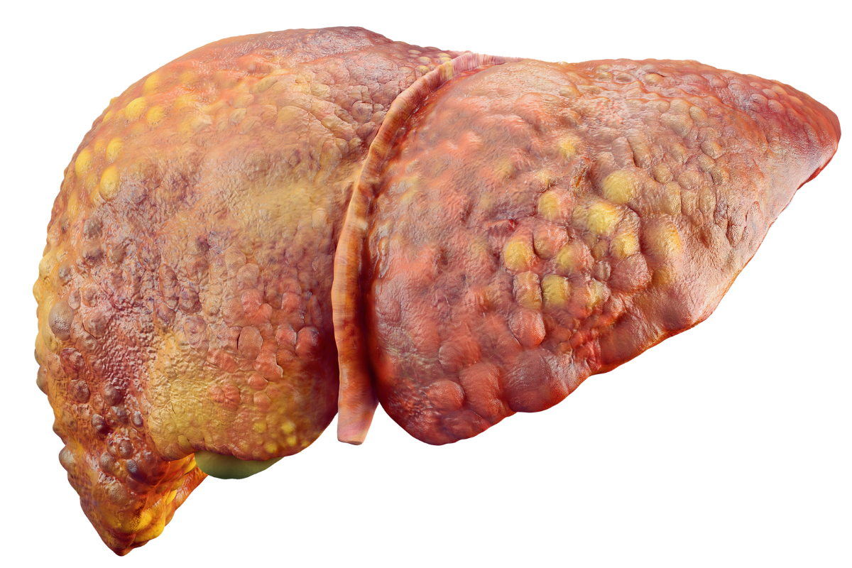 Gordura no Fígado – Por Que 30% dos Adultos Estão em Risco