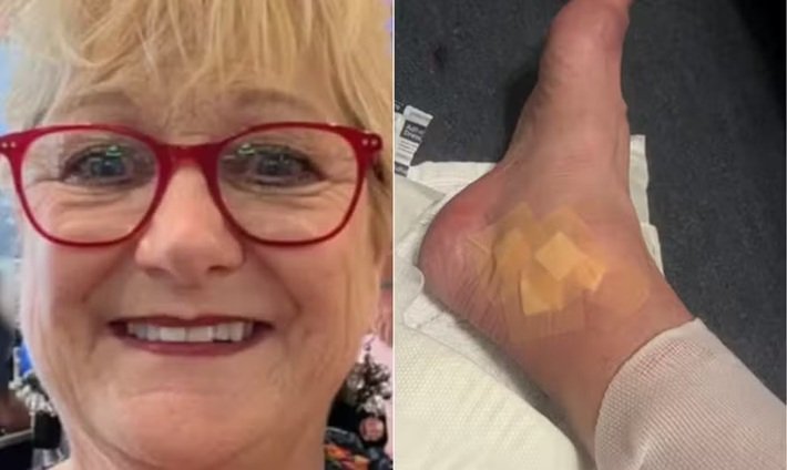 Pé com curativo composto por gaze e esparadrapo sobre um tecido branco.