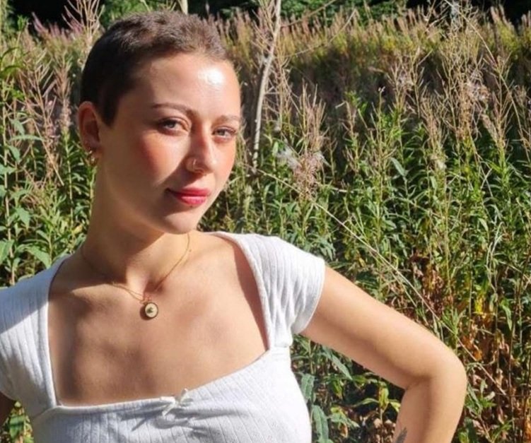 Jovem de 23 anos perde todo o cabelo após crise de estresse no trabalho